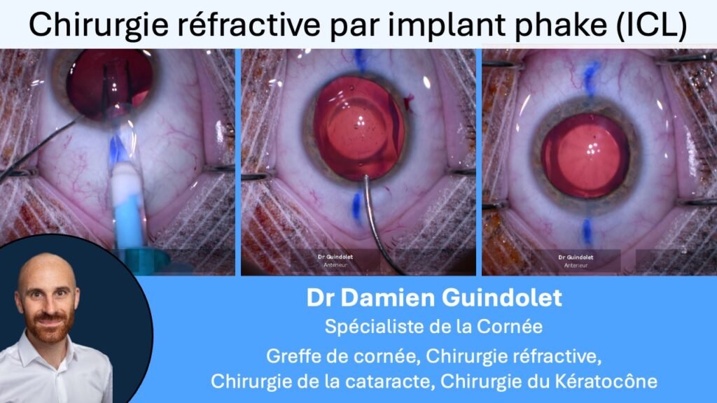 Guindolet ICL phake chirurgie