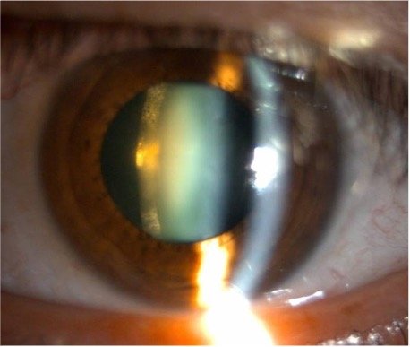 Guindolet cataracte