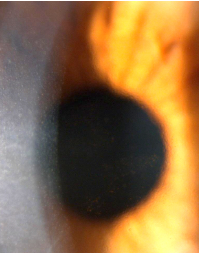 Dystrophie Fuchs endothelium DMEK speculaire