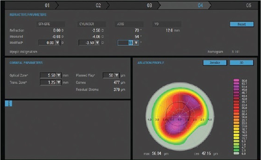 Guindolet Keratocone PKR topoguidee